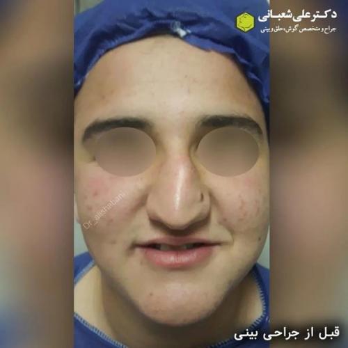 جراحی-بینی-در-بابل306