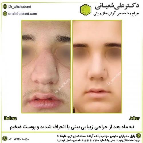 جراحی-بینی-در-بابل307