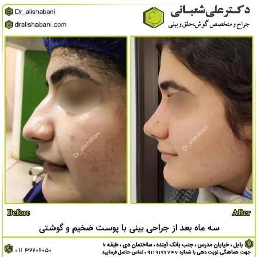جراحی-بینی-در-بابل308