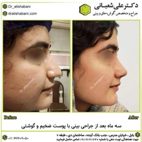 جراحی-بینی-در-بابل309