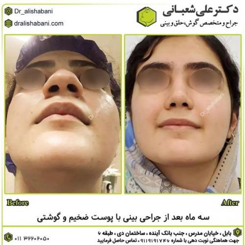 جراحی-بینی-در-بابل310