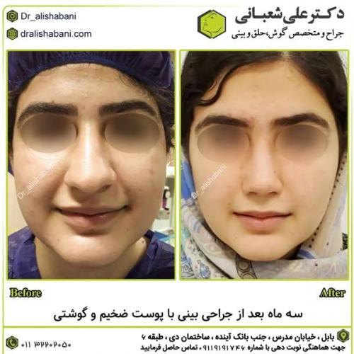 جراحی-بینی-در-بابل311