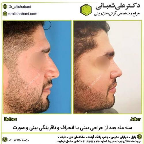 جراحی-بینی-در-بابل312