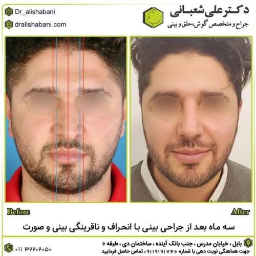 جراحی-بینی-در-بابل313