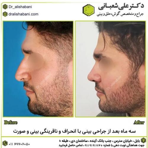 جراحی-بینی-در-بابل314