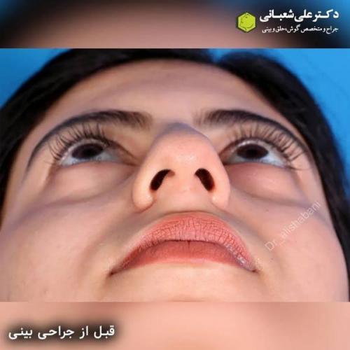 جراحی-بینی-در-بابل316