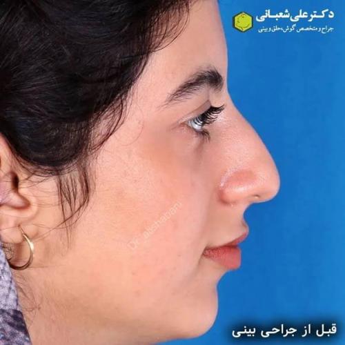 جراحی-بینی-در-بابل318