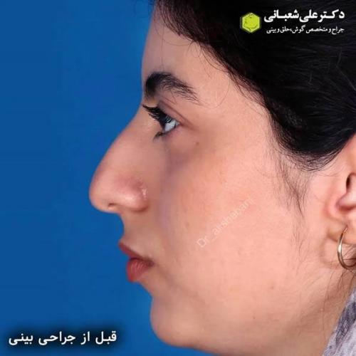 جراحی-بینی-در-بابل320