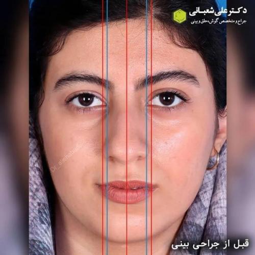 جراحی-بینی-در-بابل322