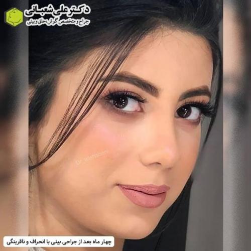 جراحی-بینی-در-بابل323