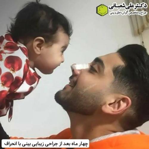 جراحی-بینی-در-بابل327