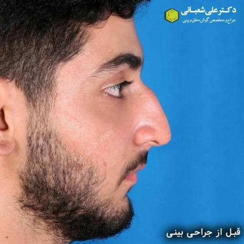 جراحی-بینی-در-بابل328