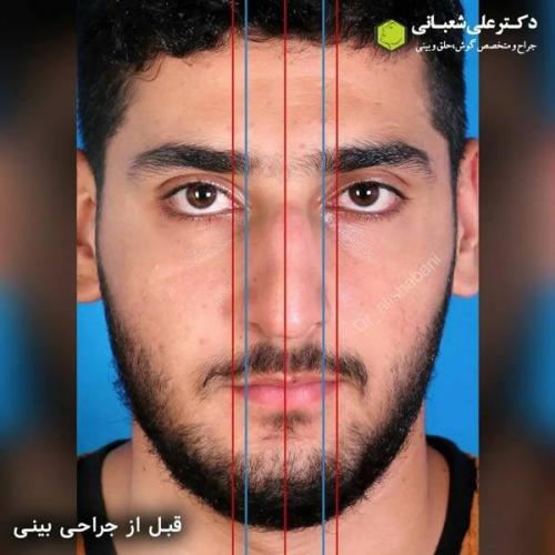 جراحی-بینی-در-بابل330