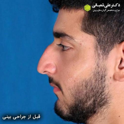 جراحی-بینی-در-بابل332