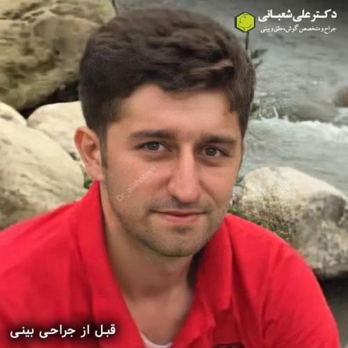 جراحی-بینی-در-بابل334