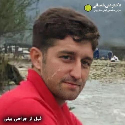 جراحی-بینی-در-بابل336