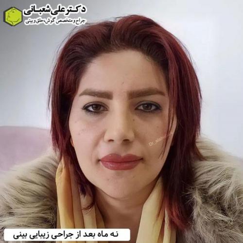 جراحی-بینی-در-بابل338