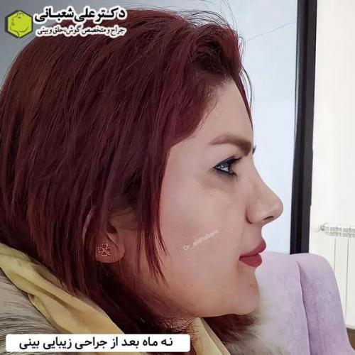 جراحی-بینی-در-بابل339