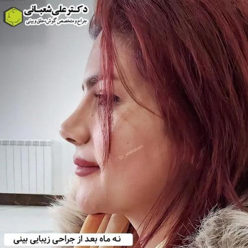 جراحی-بینی-در-بابل340