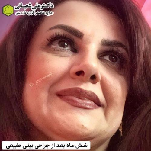 جراحی-بینی-در-بابل341
