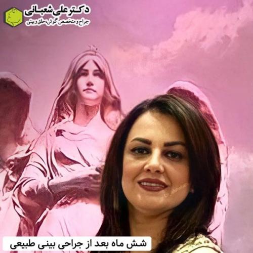 جراحی-بینی-در-بابل342
