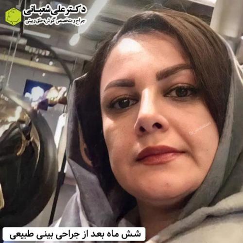 جراحی-بینی-در-بابل344