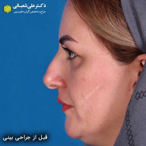 جراحی-بینی-در-بابل345