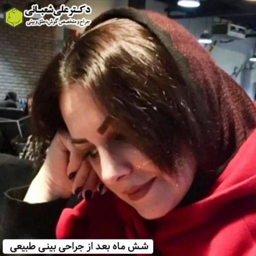 جراحی-بینی-در-بابل346