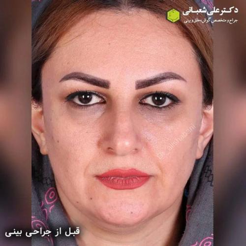 جراحی-بینی-در-بابل347