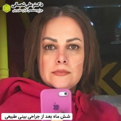 جراحی-بینی-در-بابل348