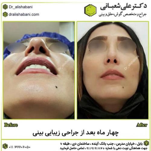 جراحی-بینی-در-بابل349