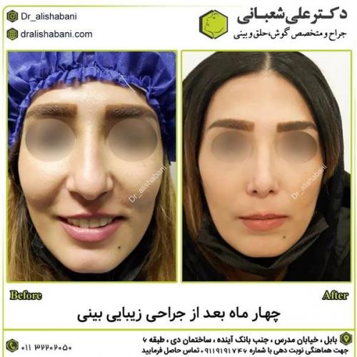 جراحی-بینی-در-بابل351