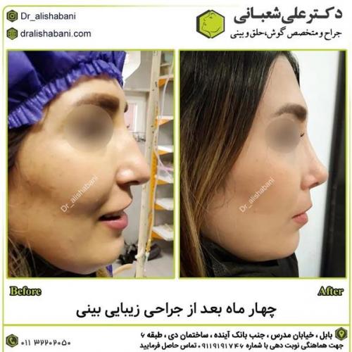 جراحی-بینی-در-بابل352