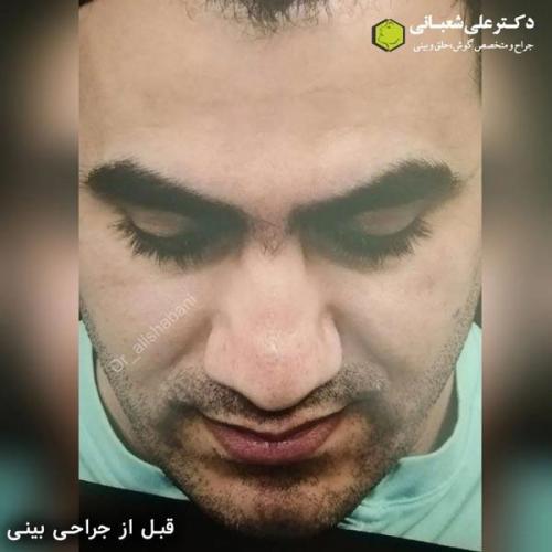 جراحی-بینی-در-بابل353