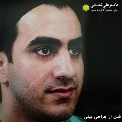 جراحی-بینی-در-بابل354