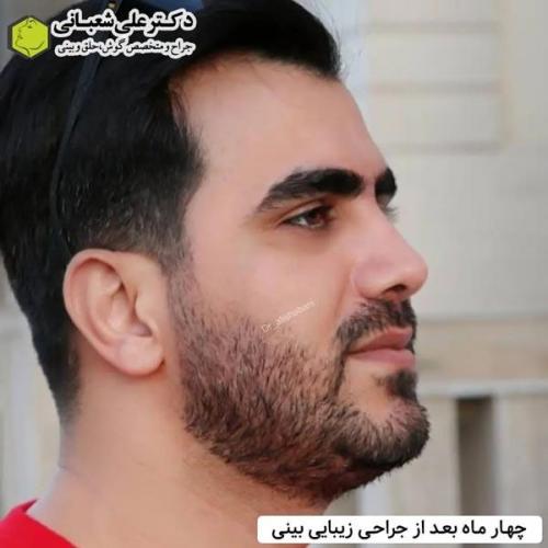 جراحی-بینی-در-بابل355