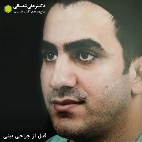 جراحی-بینی-در-بابل356