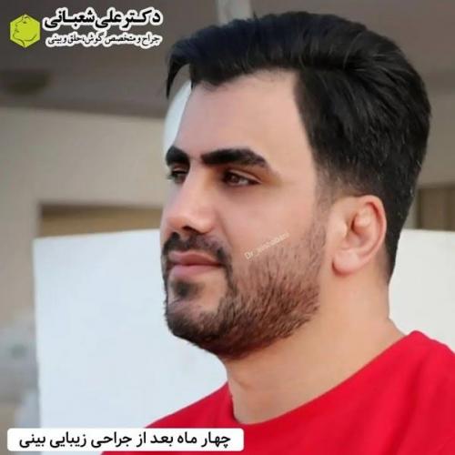 جراحی-بینی-در-بابل357