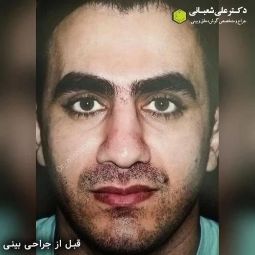 جراحی-بینی-در-بابل358
