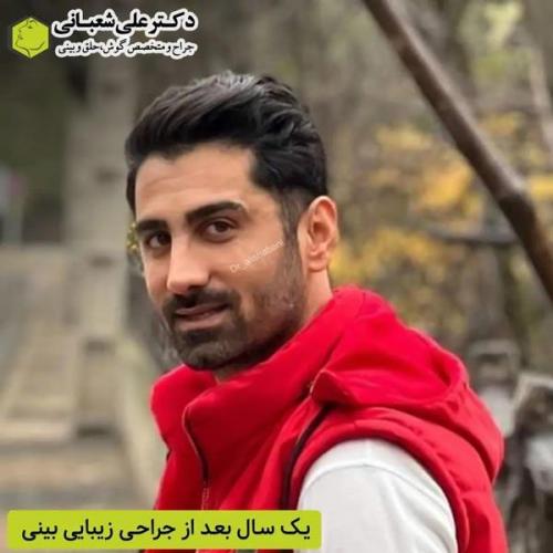 جراحی-بینی-در-بابل361