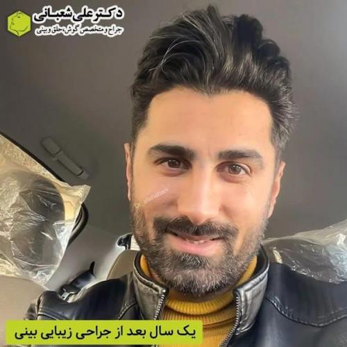 جراحی-بینی-در-بابل362