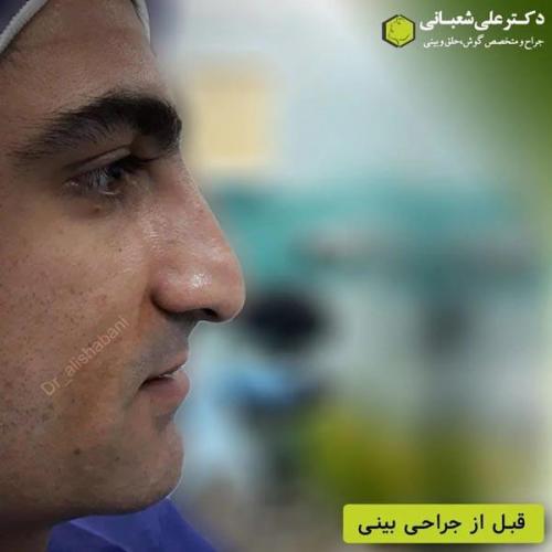 جراحی-بینی-در-بابل363