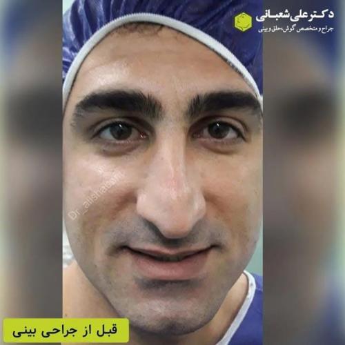 جراحی-بینی-در-بابل365