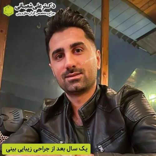 جراحی-بینی-در-بابل366