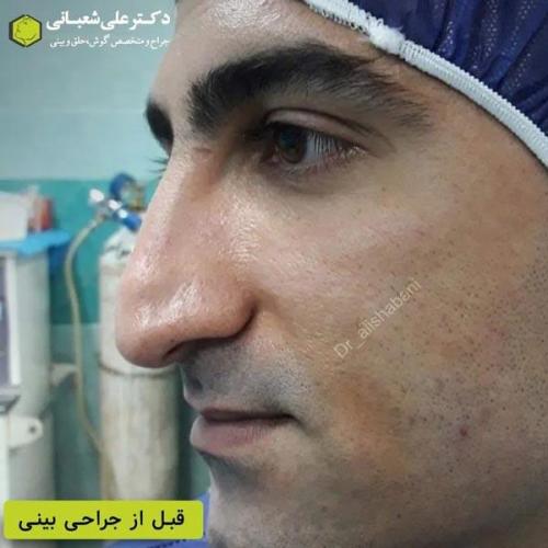 جراحی-بینی-در-بابل367