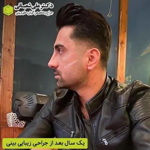 جراحی-بینی-در-بابل368