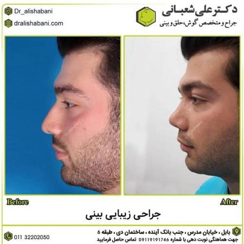 جراحی-بینی-در-بابل369
