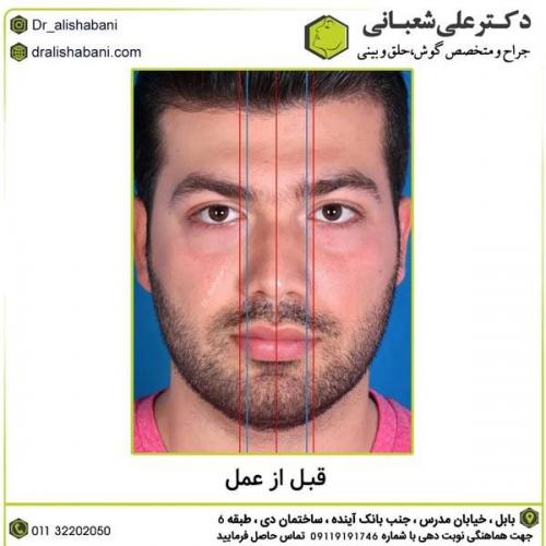 جراحی-بینی-در-بابل370