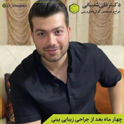 جراحی-بینی-در-بابل371
