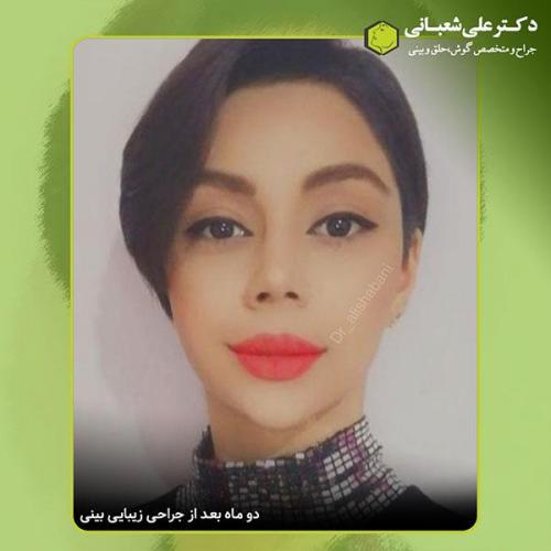 جراحی-بینی-409